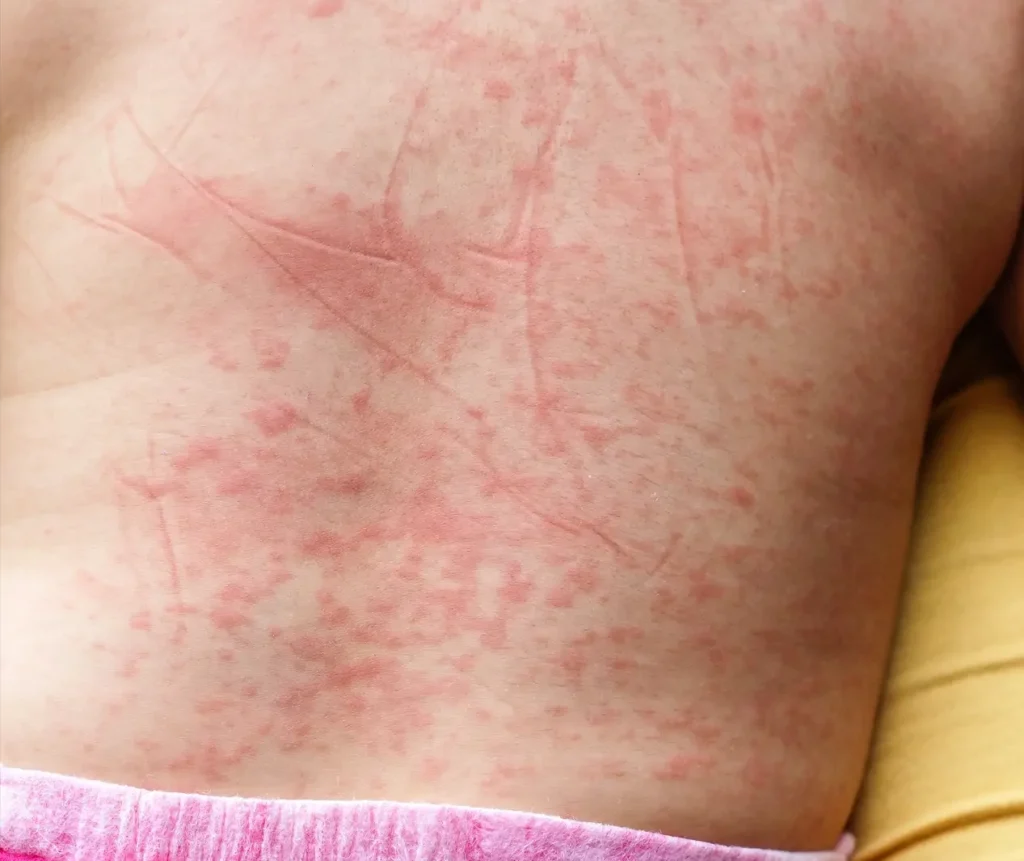 Red spots on skin, a symptom of dengue
