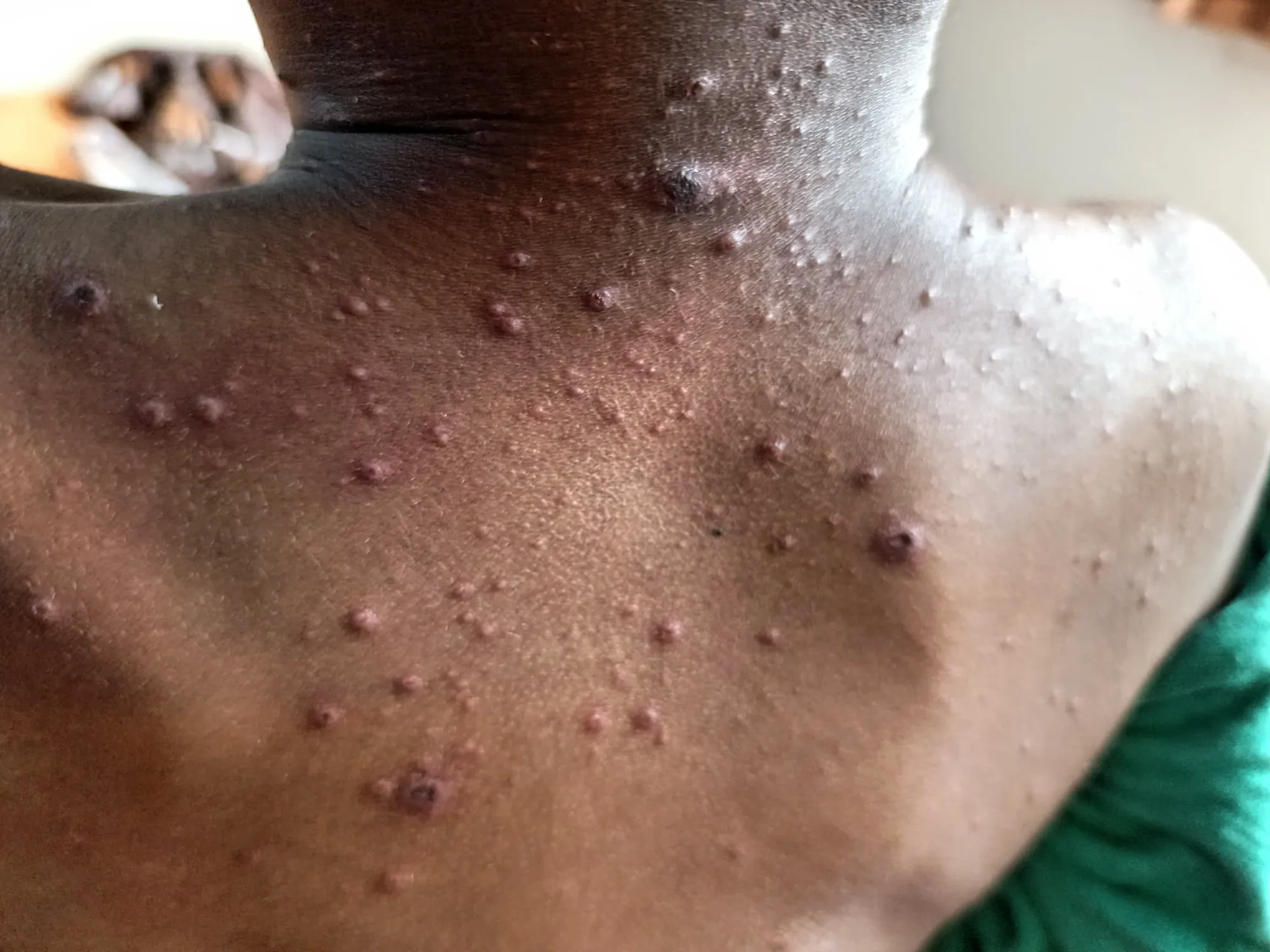 A photo of someone's back, showing a mass of lesions